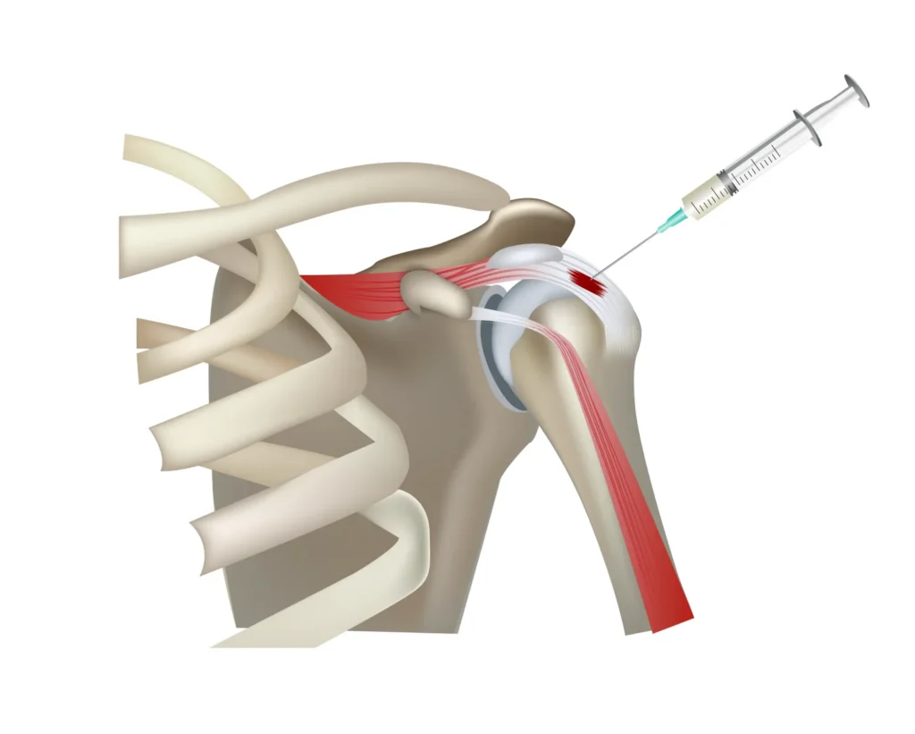 Diagram of PRP shoulder treatment