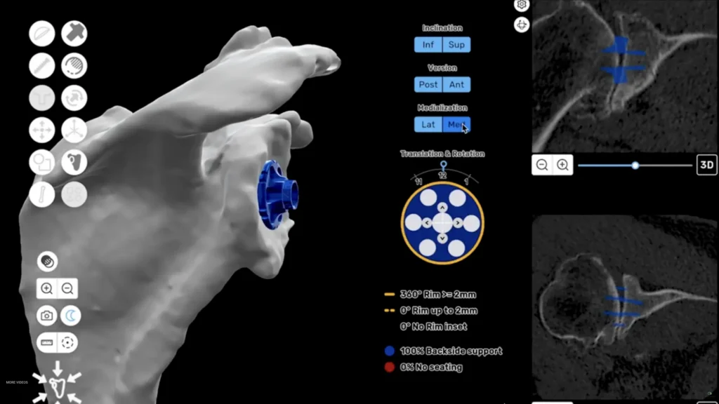 Using 3D software to plan a reverse shoulder replacement 