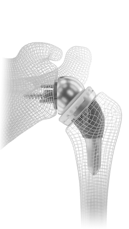 Reverse shoulder replacement implant in a bone model.