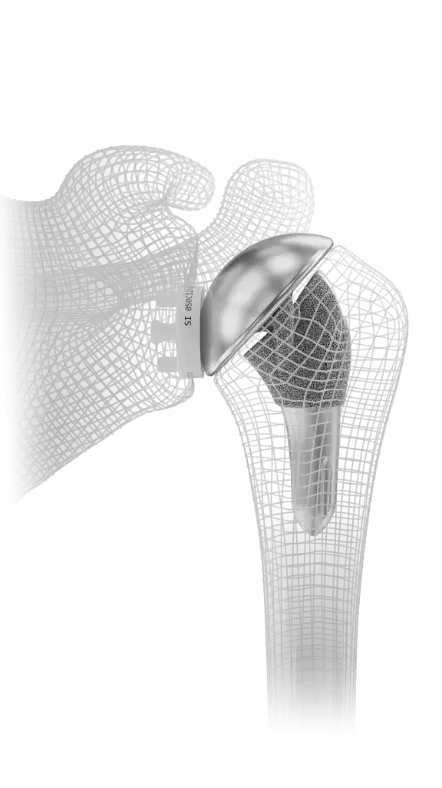 Total shoulder replacement implant in a bone model.