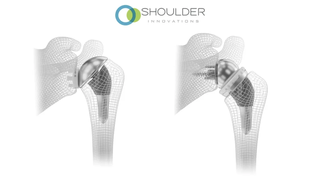 Bone models showing total shoulder replacement and reverse shoulder replacement.