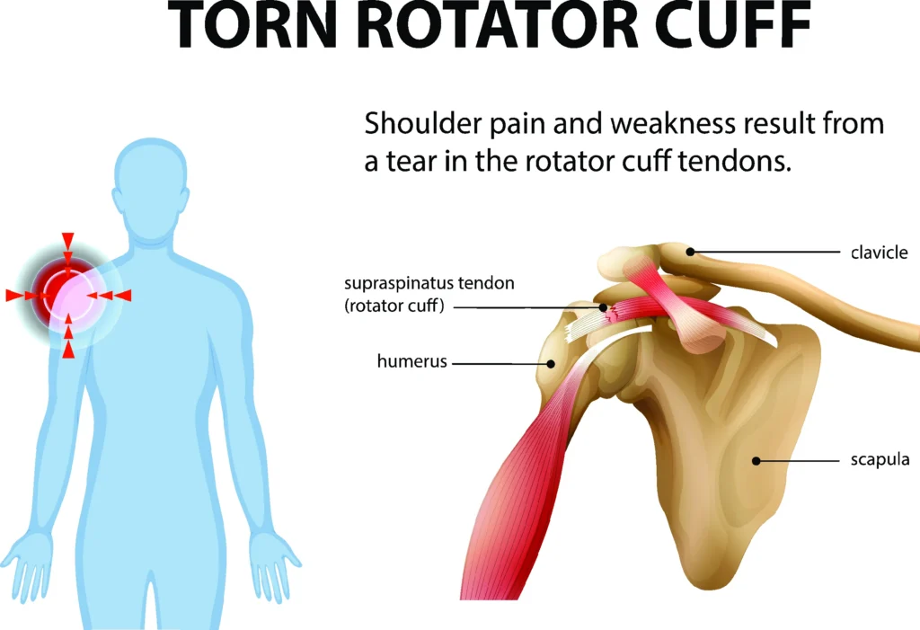 Rotator cuff diagram, showing where it is in the body and where the tendon tear is in the shoulder.