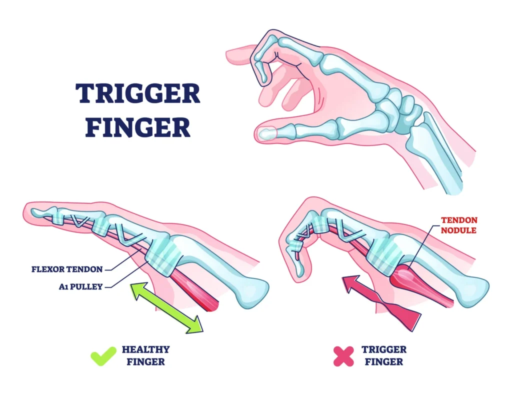 trigger finger diagram, with the difference between a healthy finger and the trigger finger with an inflamed tendon nodule.