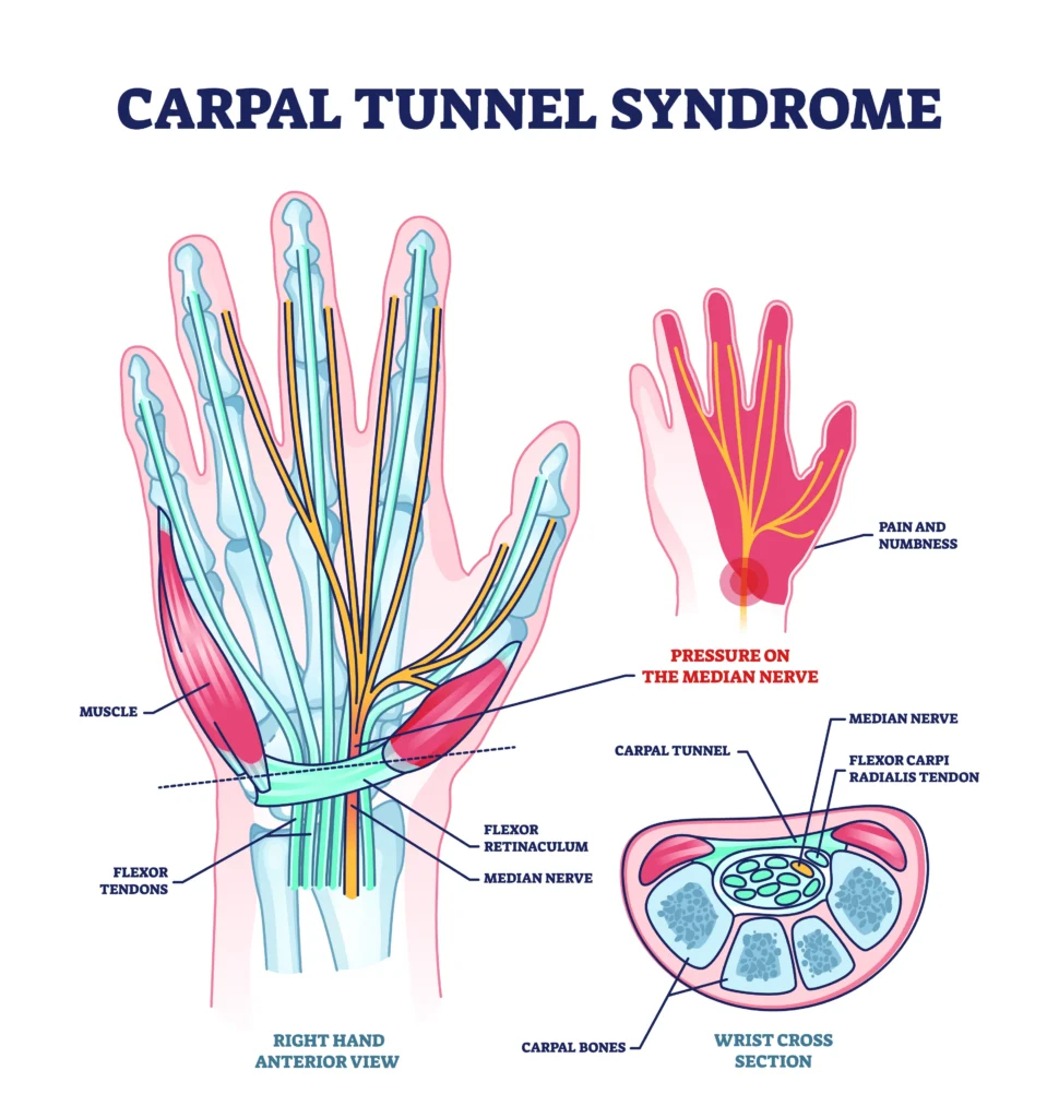 diagram of the hand anatomy when affected by carpal tunnel syndrome.