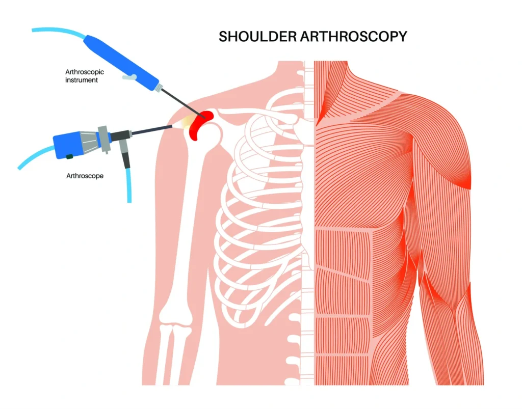 diagram of shoulder arthroscopy including an arthroscope and arthroscopic instrument.