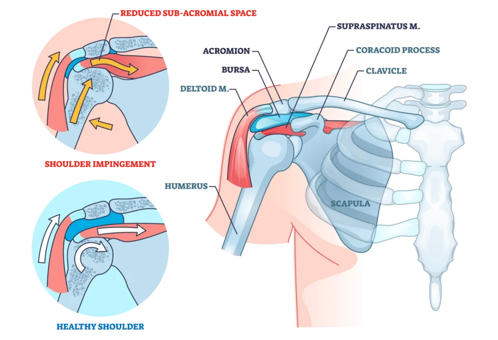 anatomical diagram comparing a healthy shoulder to one with shoulder impingement