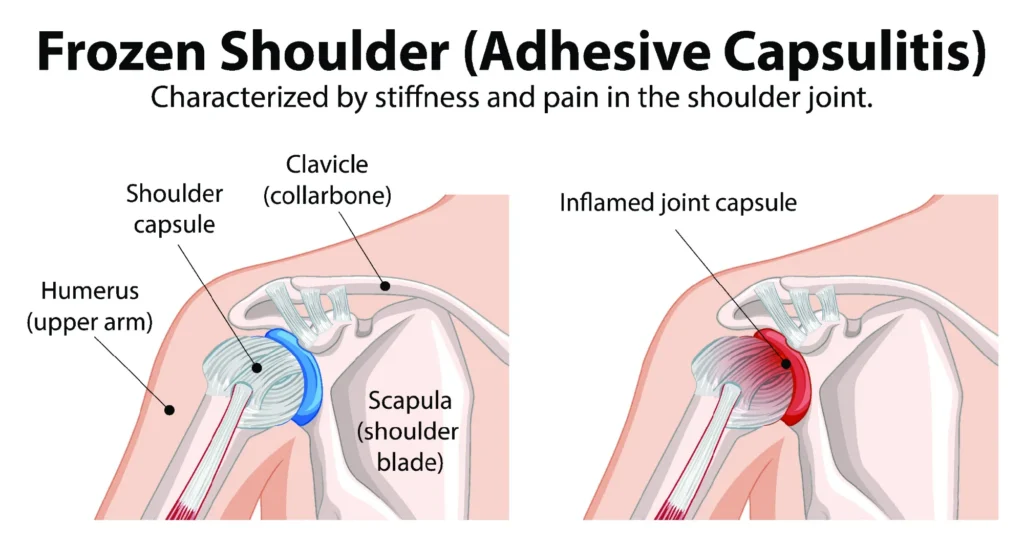 Frozen shoulder diagram comparing a healthy to a frozen shoulder