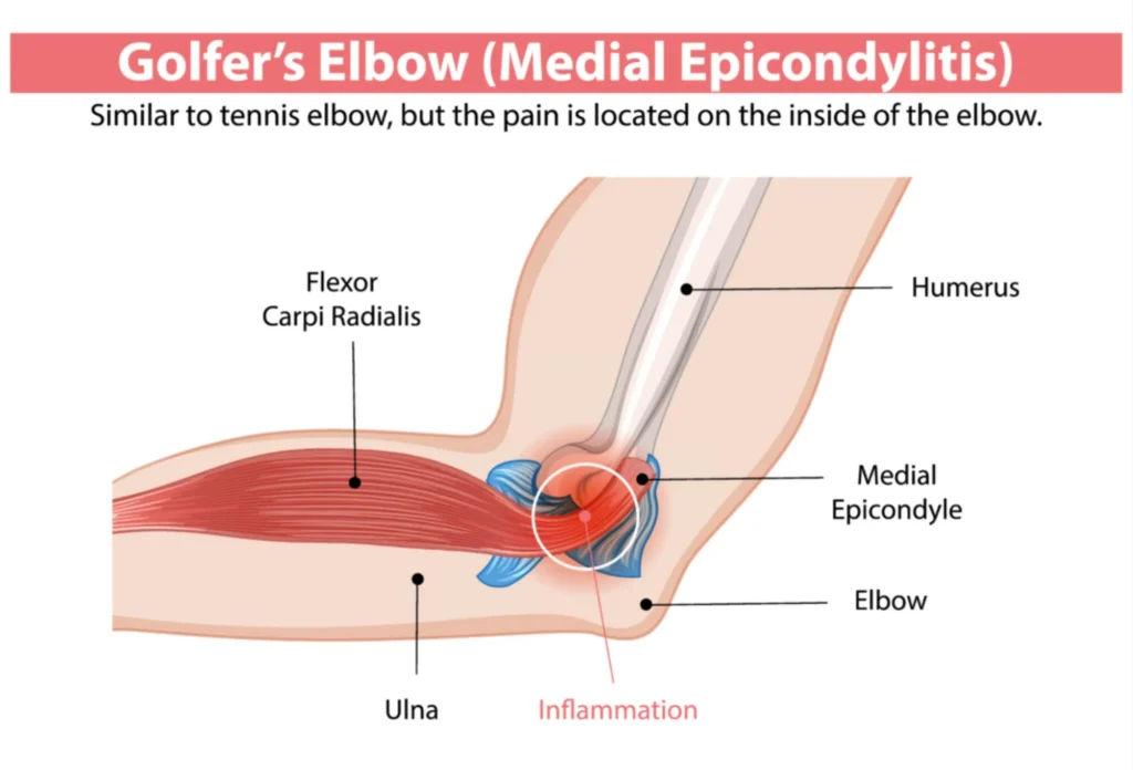 golfers elbow anatomical diagram of golfer's elbow