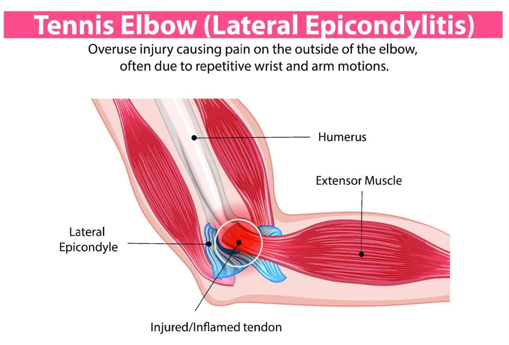 tennis elbow anatomical diagram of tennis elbow